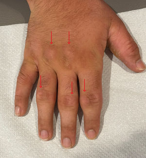 Knuckle pads (arrows) over the proximal interphalangeal and metacarpophalangeal joints of the right hand.