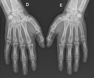 Radiograph of both hands.