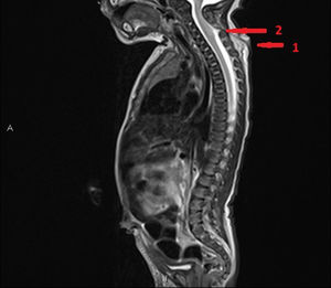 Magnetic resonance imaging. Arrow 1: visualization of ascending tract reaching the thecal sac, which is slightly dilated. Arrow 2: slightly dilated thecal sac at the level of C4-C5 with spinal cord slightly tethered toward it, including the meninges.