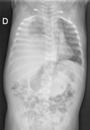 Thoracic radiograph.