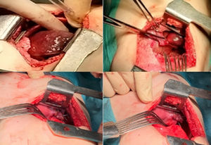 Intraoperative photographs. Incarcerated hepatic right lobe (top left). Enlargement of defect (top right). Suturing of the hernia (bottom).