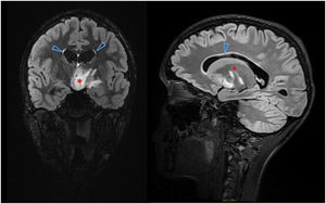 T2-weighted FLAIR images (coronal and sagittal planes, respectively) showing a poorly defined hypothalamic lesion with obstruction of the third ventricle (*) and moderate prominence of lateral ventricles with mild transependymal edema (Δ).