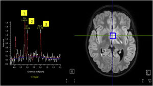 MR spectroscopy of the lesion showing a spectrum incompatible with a brain tumor: elevation of choline (1), creatine (2) and N-acetylaspartate (NAA) (3).