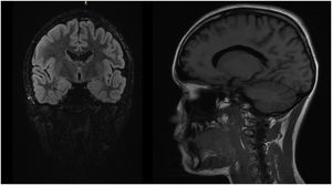 T2-weighted FLAIR images (coronal and sagittal planes, respectively) showing complete radiological resolution after steroid therapy.