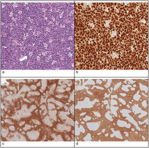 Histological features of a lymph node biopsy specimen compatible with PTGC: (a) hematoxylin–eosin staining: follicles with enlarged germinal centers surrounded by eccentric mantle zone layers with poorly defined margins; (b) PAX5 immunostaining: nuclear staining in B cells in the mantle zone, useful to differentiate normal lymphoid tissue and some types of Hodgkin lymphoma; (c) CD3 immunostaining: abundance of mature T cells in the mantle zone; (d) BCL2 immunostaining: positive expression in mantle and T cells but not in germinal centers, contrary to follicular lymphoma (in which germinal centers are BCL2+).