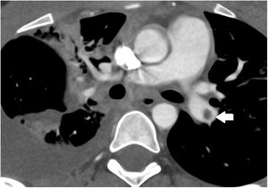 Computed tomography scan with contrast showing complicated pneumonia with effusion in the right lung. The right arrow points at a filling defect observed in the left pulmonary artery related to the pulmonary thromboembolism.