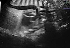 Prenatal ultrasound. 2D mode. Sagittal view. Ductal arch with aneurysmal dilatation.