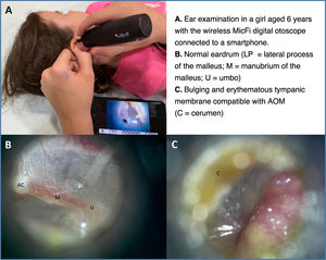 Otoscopy with the digital Mic-Fi otoscope.