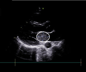 Echocardiogram showing left atrial myxoma (white circle) measuring 33 mm × 27 mm.