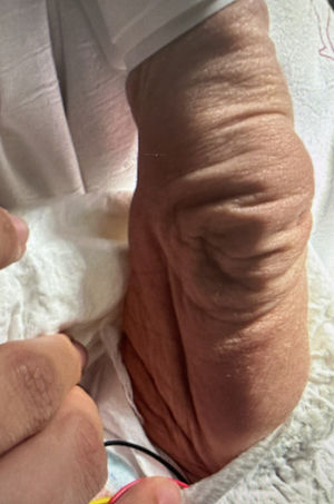 Skin pinch test causing persistent tenting in the neonate with severe hypernatremic dehydration.