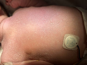 Superficial vesicular lesions over the trunk, consistent with miliaria crystallina, that appeared three days after rehydration and resolved within five days with supportive skin care.