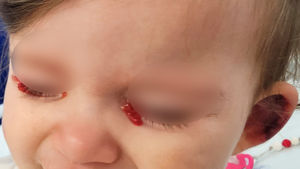 Bilateral hemolacria and purpuric lesion on the left earlobe.