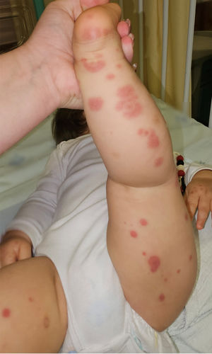 Multiple targetoid purpuric lesions predominantly involving the lower extremities.