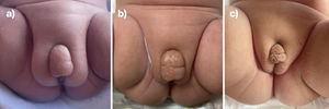 Clinical course: substantial swelling in the hypogastric and genital areas with enlargement of the labia majora and clitoris, which improved during follow-up. (a) Age 3 months (36+3 weeks of postmenstrual age). (b) Age 4 months (2 weeks of corrected age [CA]). (c) Age 8 months (4 months of CA).