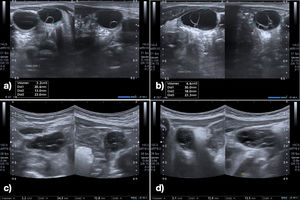 Ultrasound images of the ovaries showing bilateral ovarian septate cysts. a) Left ovary (LO) at 3 months with a volume of 3.2cm3. (b) Right ovary (RO) at 3 months with a volume of 6.6cm3. (c) LO at 4 months with a volume of 2.2cm3. (d) RO at 4 months with a volume of 2.1cm3.