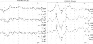 P300 cognitive evoked potentials. The image on the left shows the responses to the frequent stimulus. The image on the right shows the responses to the target or infrequent stimulus, where the P300 wave is recorded.