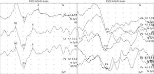 Comparison of P300 responses from a subject with ADHD (left) and a control subject (right). The P300 latency is visibly delayed in the subject with ADHD, although there was no clear difference in amplitude.