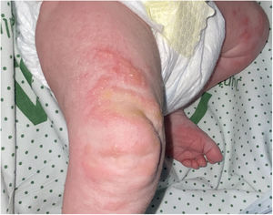 Papulovesicular plaques in the lower extremity.