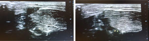 Ultrasound images. Right side, muscles at rest; left side, muscles contracted.