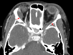 Axial orbital CT image showing the reported findings, marked by red arrows.