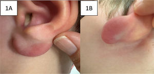 (A) and (B) Lymphocytoma on arrival to the emergency department.