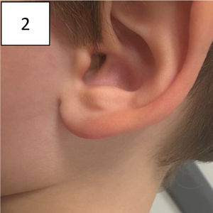 Lymphocytoma after three weeks of treatment.