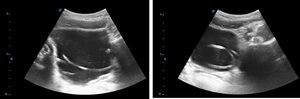 Point-of-care ultrasound with convex probe. Transverse plane. Visualization of a foreign body that formed several loops.