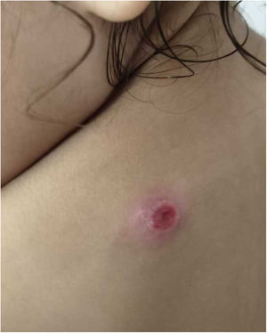 Cutaneous lesion measuring approximately 1.5 cm in the left scapular region with a serous-exudative center, a peripheral inflammatory halo, and fine scaling.