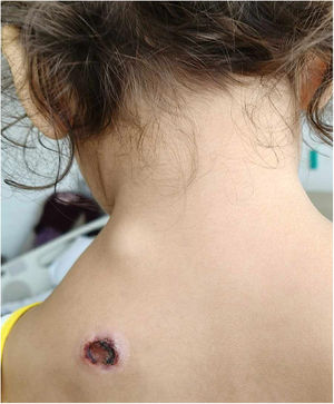Progression to nodular, erythematous plaque in left scapular region with a central scaly ulcer, peripheral inflammatory halo, and raised margins. The lesion was associated with manifest regional lymphadenopathy.