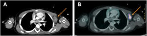 PET/CT scan with 18F-FDG. (A) CT component with intravenous contrast: matted left axillary lymph nodes (arrow). (B) Fused PET/CT image: increased FDG uptake in the same area (arrow).