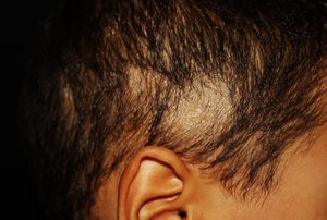 Gray patches of hair loss with fine scaling in the right temporo-occipital region.