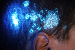 Wood’s lamp test showing blue-green fluorescence in hair loss areas, suggestive of ectothrix dermatophyte infection.