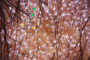 Trichoscopic image showing multiple perifollicular casts (green triangle) and Morse code-like hairs (yellow arrows), characterized by alternating light and dark bands along the hair shaft. These findings are indicative of areas of ectothrix fungal invasion.