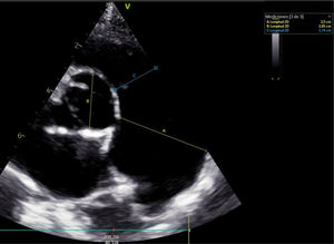 Echocardiogram, parasternal short axis view. Line A: diameter of the main pulmonary artery (3.5 cm); Line B: diameter of the aorta (2.01 cm); Line C: diameter of the pulmonary valve annulus (1.74 cm).