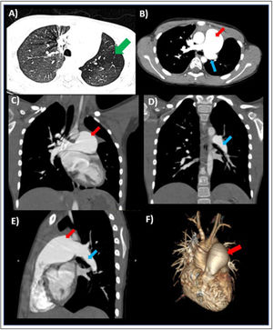Contrast-enhanced computed tomography of the lung. (A) Axial view showing air trapping in the left upper lobe (green arrow). (B) Axial view. (C) and (D) Coronal views. (E) Sagittal view. (F) 3D cardiac reconstruction. Red arrows: main pulmonary artery; blue arrows: left pulmonary artery.