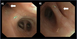 Flexible bronchoscopy. (A) View from the left main bronchus. Luminal stenosis of the upper lobe bronchus (white arrow). B) View from the entrance to the left upper lobe. Bronchial stenosis (or decreased bronchial caliber) of the lingula due to extrinsic compression (white arrow). For a better understanding of the bronchoscopy findings, refer to the supplementary material (Video).