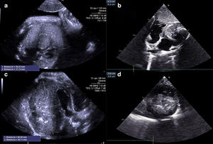(a) Fetal echocardiogram at 35+4 weeks of GA. Four-chamber view showing a 26 × 17 mm tumor in the left ventricle. (b) Echocardiogram following tumor resection at age 2 months, subcostal view (41 × 51 mm). (c) Echocardiogram at age 4 months, parasternal long-axis view, intracardiac tumor (60 × 35 mm). (d) Short-axis view showing tumor dimensions of 36 × 35 mm at age 3 years and 9 months.