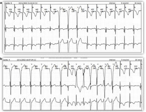 (a) Holter tracing showing triplets. (b) Holter tracing showing run of nonsustained ventricular tachycardia.
