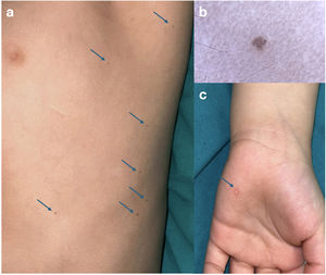 (a) Multiple punctate brown papules located on the left side of the trunk, clinically and histologically consistent with basal cell carcinoma. (b) Dermoscopic image of one of the basal cell carcinomas showing blue-gray nests and globules. (c) Palmoplantar pit.