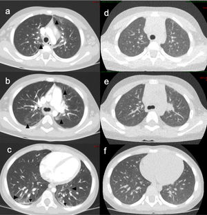 (a–c): initial contrast-enhanced CT scan, with acquisition of images in full inspiration with the patient under sedation and ventilated via a laryngeal mask. Perihilar and peripheral areas of ground-glass opacity (arrowheads). Peripheral linear bands in the lower lobes (black arrows). (d–f): Follow-up CT scan after treatment (acquired during spontaneous breathing without intravenous contrast). Complete radiological resolution, with no residual lesions. Resolution of parenchymal involvement.