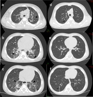 (a–c): initial chest CT showing diffuse ground-glass opacities with a central/perihilar distribution, predominantly in the lower lobes, and peripheral involvement of the anterior and apicoposterior segments of the left upper lobe. Patchy peripheral linear atelectasis and bibasilar peribronchovascular thickening are also present. (d–f) Follow-up chest CT after treatment showing resolution of the ground-glass opacities, peribronchovascular thickening, and peripheral atelectasis. Residual parenchymal bands persist in the right upper and lower lobes (hollow arrows).