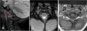 Cervical spine MRI. (A) Sagittal T2 STIR sequence: joint effusions at the C1-C2 level, more pronounced on the right (red arrow), associated with mild edema of the right occipital condyle and lateral mass of C1. (B) These were also observed on the axial fat-saturated T2-weighted sequence. (C) Axial T1-weighted spin-echo image: preserved fat planes, with no evidence of osseous erosion or soft tissue masses. No intravenous contrast was administered.