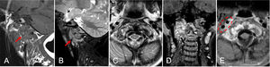 Cervical spine MRI. (A) Sagittal T1-weighted spin-echo image: intermediate to low-signal ill-defined lesion involving the posterior clivus, occipital condyles, and right-sided elements of C1 and C2 (red arrow), including small foci of hyperintensity suggestive of intratumoral hemorrhage or mucinous content. Sagittal T2 STIR (B) and axial T2-weighted spin-echo (C): hyperintensity in the affected vertebrae and adjacent prevertebral soft tissues (red arrow). Coronal (D) and axial (E) post-contrast T1-weighted Dixon water-only images: heterogeneous contrast enhancement. Lesion extending into the right prevertebral and carotid space (dashed ellipse), with epidural involvement at the right lateral aspect of C1, without evidence of spinal cord compression.