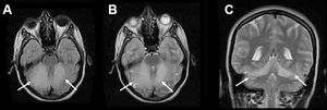 Axial T2-weighted FLAIR image (A) and axial (B) and coronal (C) T2-weighted images showing symmetric hyperintense areas involving the superior third of both cerebellar hemispheres (arrows), with effacement of the cerebellar folia.