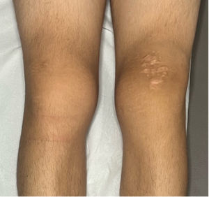 Bilateral knee swelling.