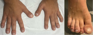 Clubbing of fingers and toes.