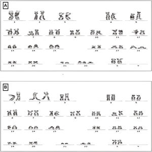 Karyotype on skin fibroblasts confirming mosaic trisomy 22. (A) 47,XX in 25% of analyzed metaphases. (B) 46,XX in 75% of analyzed metaphases.