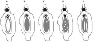 Tipos morfológicos de hímen resultantes de processos de imperfuração anómalos/incompletos. A - hímen normal, orifício vaginal permeável; B - hímen imperfurado; C – hímen microperfurado; D - hímen cribiforme; E - hímen septado.