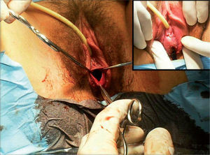 Tratamento cirúrgico de hímen imperfurado (sangue viscoso, castanho tipo chocolate - em cima e à direita).