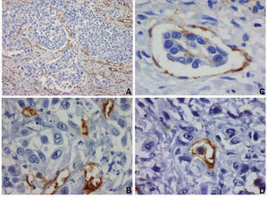CD31 and D2-40 immunoexpressions in urothelial bladder carcinoma. Intratumoral blood vessels highlighted by CD31 (A, ×100 amplification, and C, ×400 amplification), and intratumoral lymphatic vessels highlighted by D2-40 (B and D, ×400 amplification), in invasive urothelial carcinoma. Evidence of internal negative control in B (* D2-40 negative blood vessel). A small malignant embolus and an isolated malignant cell are invading intratumoral blood (C) and lymphatic (D) vessels (adapted from Afonso et al.44).